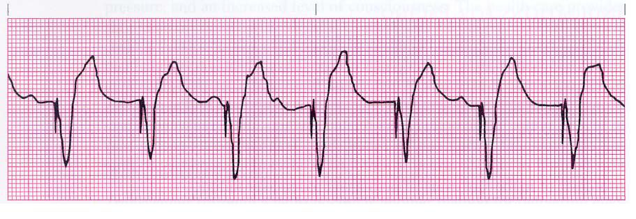 ekg+strips